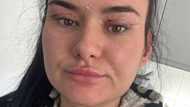 Açık yaralar, kapanmayan gözler: Kadınlardan gözkapağı ameliyatı uyarısı